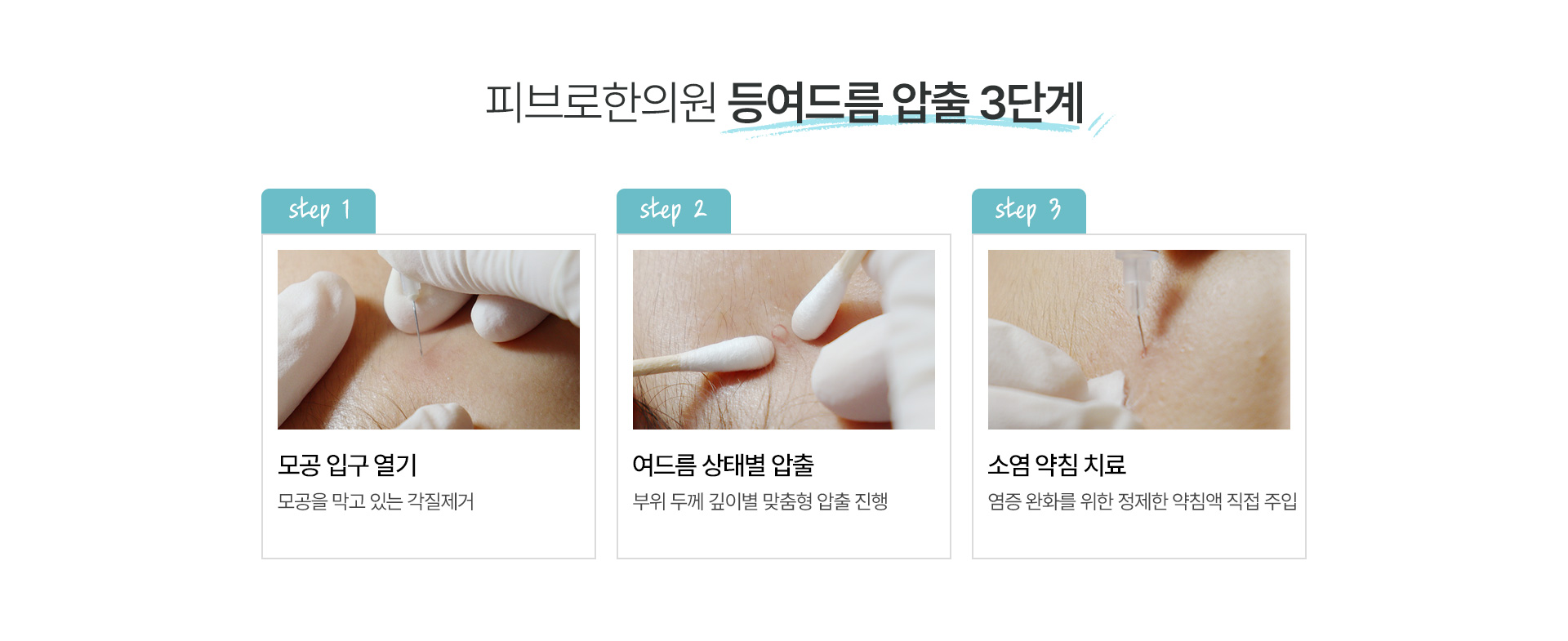 등,가슴여드름 치료