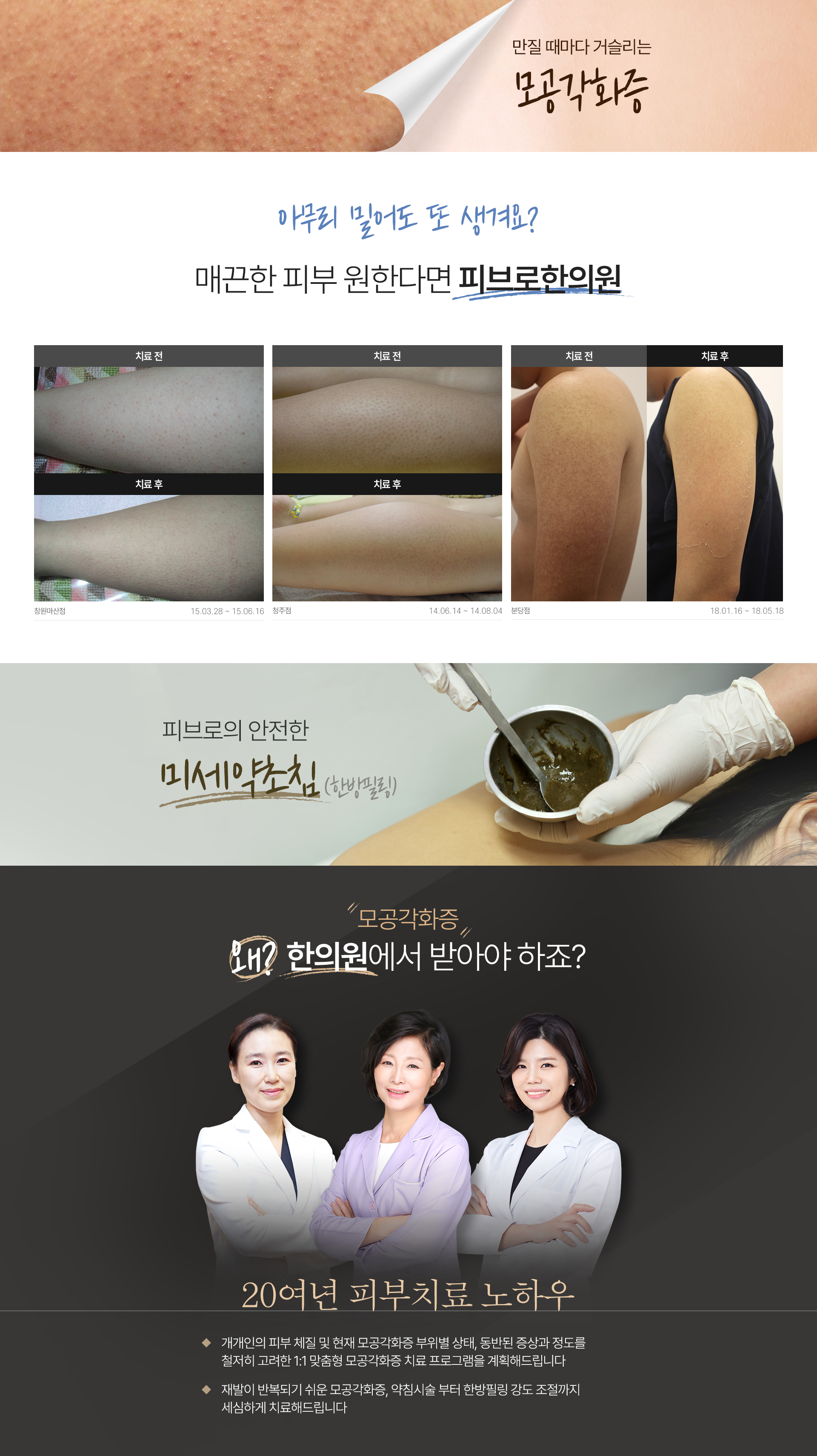 모공각화증 치료