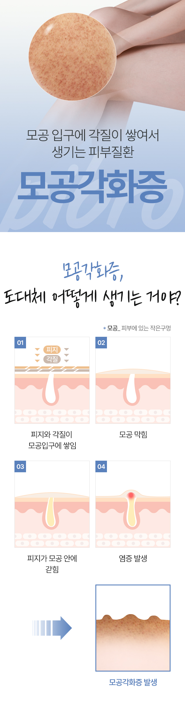 모공각화증 치료